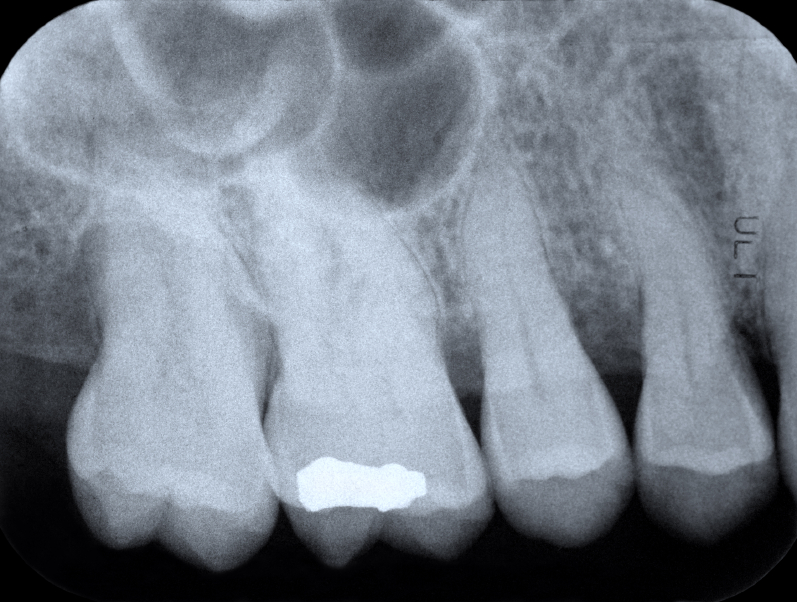 Roots in the sinus…what does this mean? Dentist in