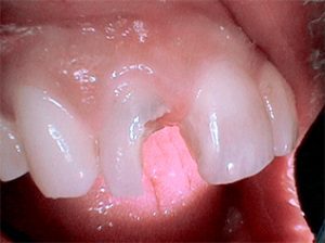 A large filling fell out of a patient’s front tooth. Ideally, it should receive a crown, because it is such a large filling. However, the tooth is too compromised (weakened) to consider placing one.