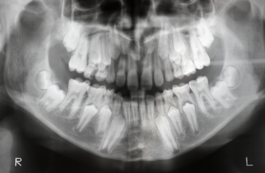 Anatomy of your child’s jaw - Dentist in Brampton, ON - Brampton Dentist